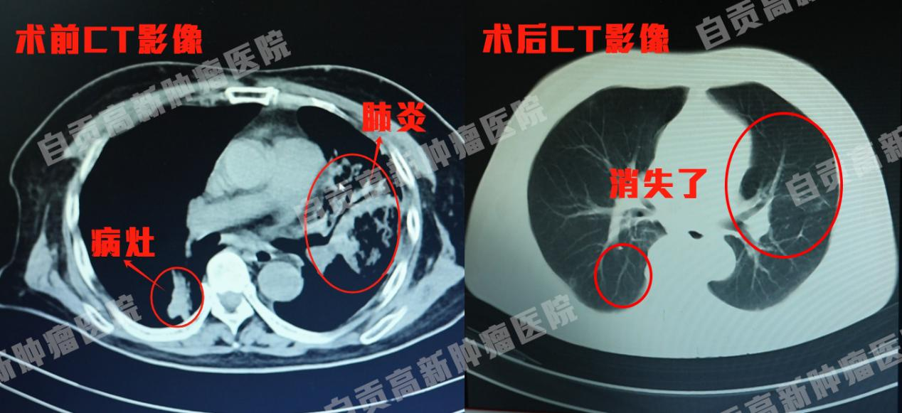 肺鱗癌伴上腔靜脈綜合征難阻生命步伐，介入治療讓患者重獲新生