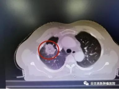 【肺癌】肺癌三期難手術(shù)，超精細(xì)介入見(jiàn)奇效！