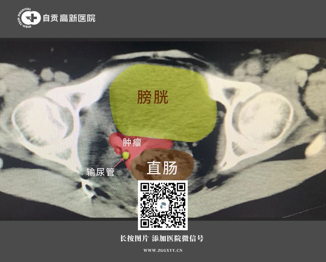 【宮頸癌】宮頸癌腫瘤復(fù)發(fā)壓迫多處器官，痛苦至極，介入治療快速縮小腫瘤！