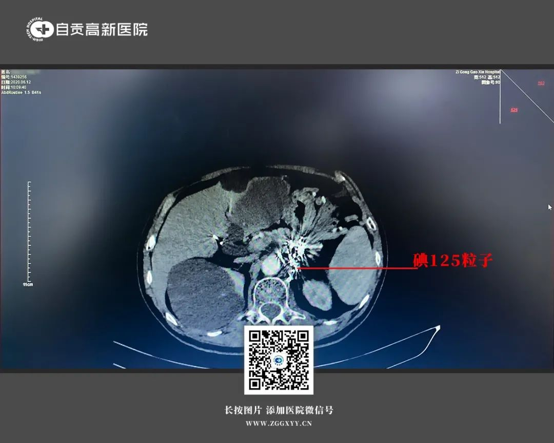 【胰腺癌肝轉(zhuǎn)移】胰腺癌肝轉(zhuǎn)移晚期命懸一線(xiàn)，死里逃生，無(wú)懼未來(lái)！
