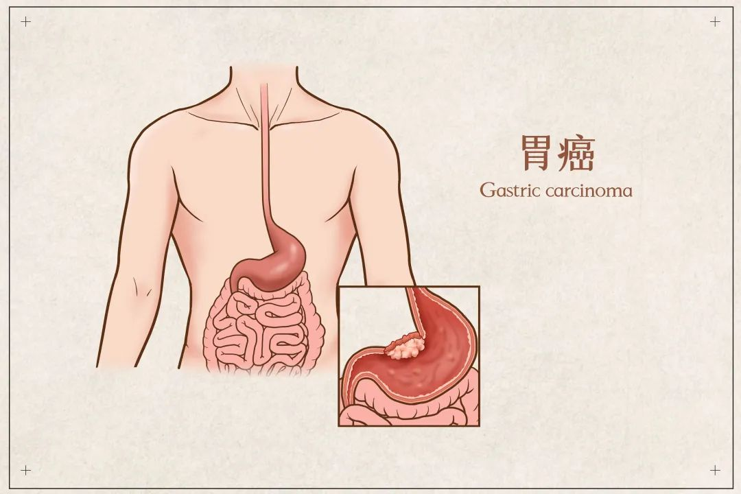 【胃癌復(fù)發(fā)全身骨轉(zhuǎn)移】多家醫(yī)院放棄治療，3次介入2個(gè)月重獲新生